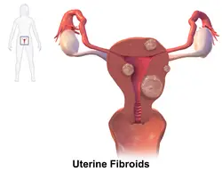 uterine fibroids